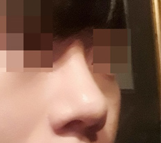 남자코도 완벽하게 해주셨습니다.