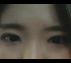 앞트임, 눈매교정 했어요!