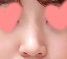 자연스럽지만 오똑해진 코 때문에!