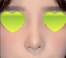 코수술 했는데 잘 됐는지 봐주세요 ^^