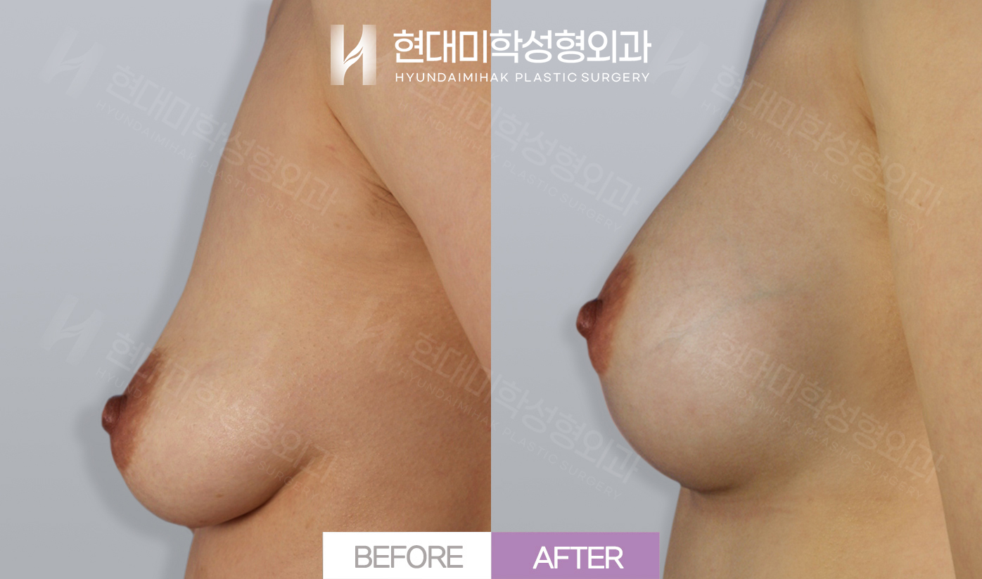 가슴확대 (쳐진가슴)