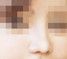 코수술 마음에 쏙들어용