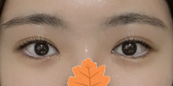 인아웃라인 쌍수 성공했어요!ㅎㅎㅎ