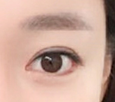 현대미학에서 트임재수술 받았어요 채고채고~