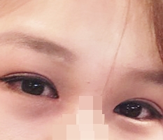 절개,눈매교정,앞트임,듀얼트임