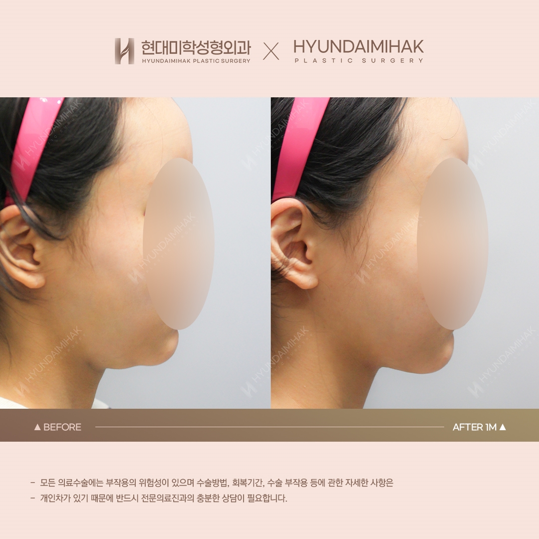 [리프팅] 이중턱 실리프팅 1개월 차