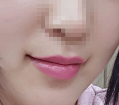 입꼬리성형한거 후기 올려용~