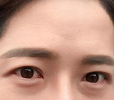 쌍꺼풀,눈매교정 했습니다.