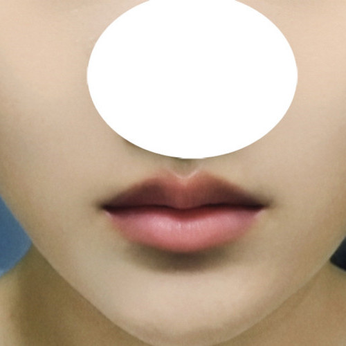 두툼한 윗입술 고민 큐피트라인으로