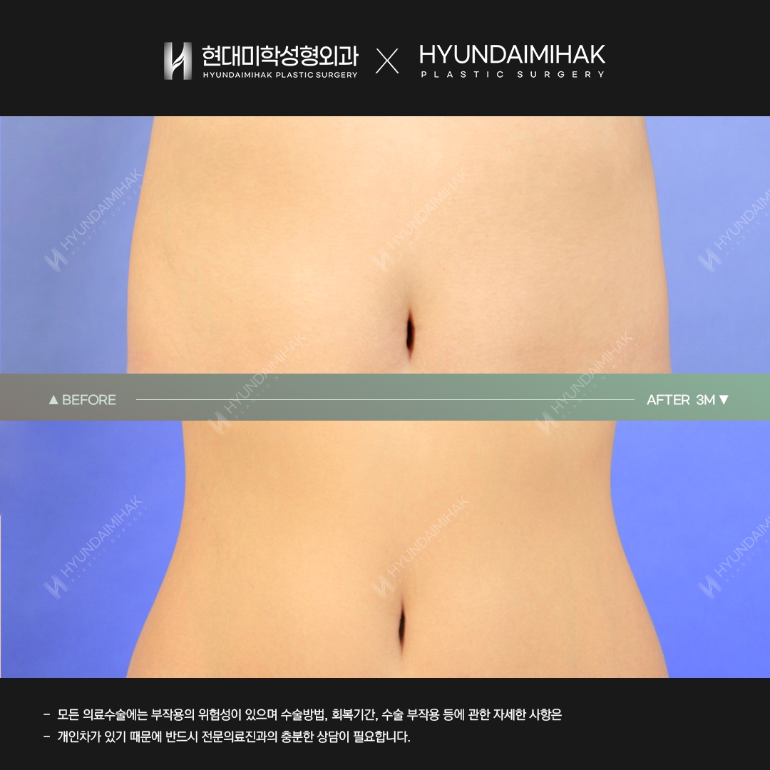 복부지방흡입 3개월차
