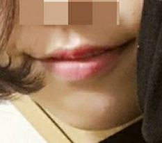 현대미학에서 입꼬리수술 받길 정말 잘한 것 같아요 ㅋㅋ