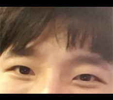 눈수술 후기입니다ㅋ