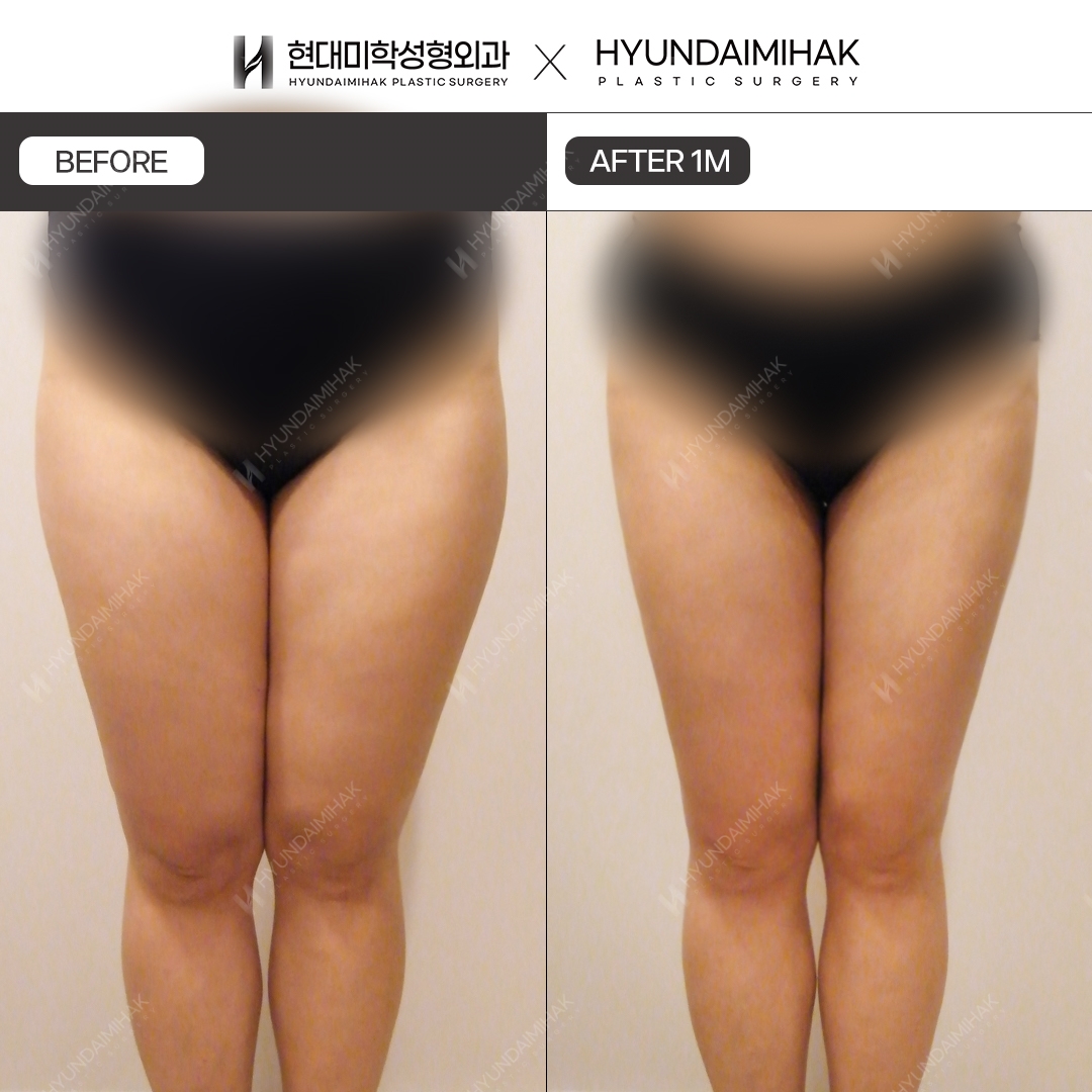허벅지 지방흡입 1개월차