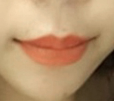 만족도가 가장 높았던 입꼬리성형 :-)