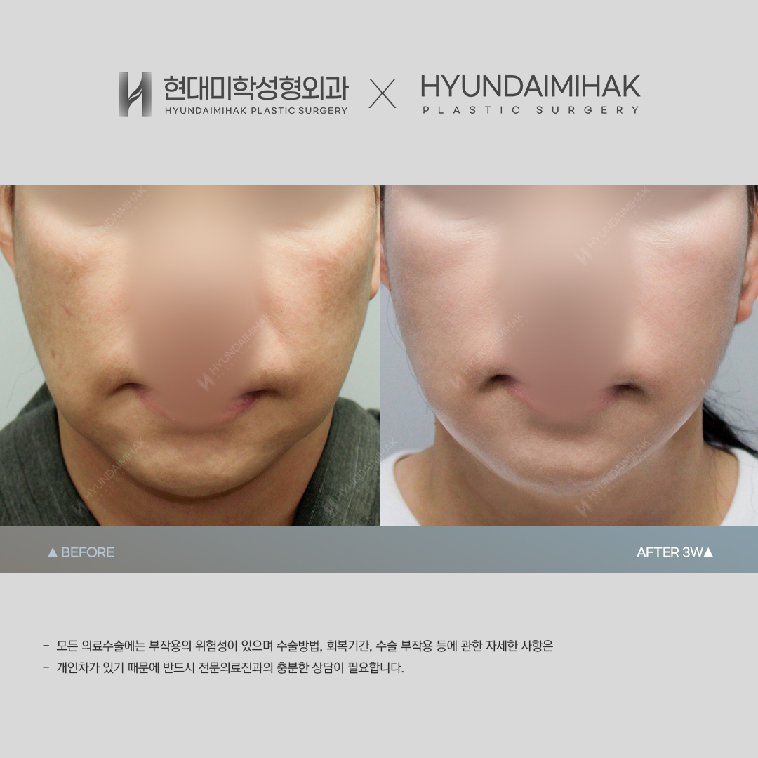 [동안성형] 실리프팅 3주 차