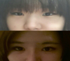 눈코수술로 이미지변신 성공했어요:)