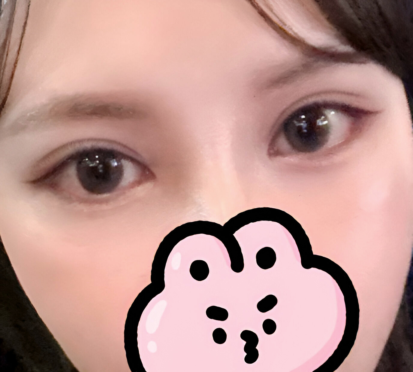 세미아웃라인으로 눈재수술💗