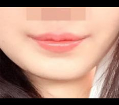 입꼬리 성형 신기방기
