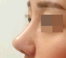 수술 한지 얼마 안됐는데 벌써 마음에 드네요