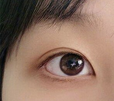 쌍수 세달차 되서 후기 또 남기러 왓어용