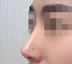 코수술하고 훈남됐다는 말 많이 듣는중