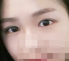 눈절개,눈매교정,앞,뒤트임