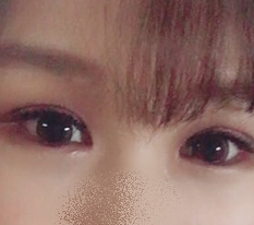 쌍꺼풀수술로 눈이 달라졌어용 ♥