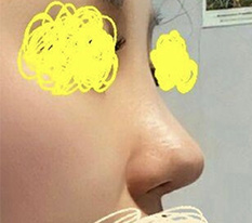 코수술 3주차 후기 또 올리러 왔어용