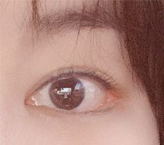 트임 후기 솔직하게 썼어요