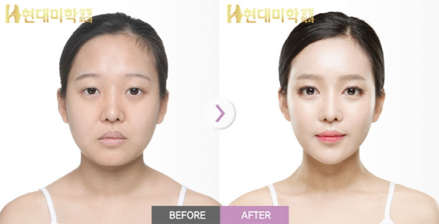 눈(절개),앞트임,뒤트임,밑트임,지방이식