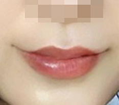 우왕 처진 입꼬리 개선 성공!!!!!!!!