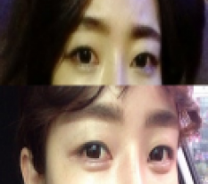 필러시술 후 귀요미됨 >3<
