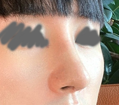 매부리코 해결했는데 남자다워졌다네요