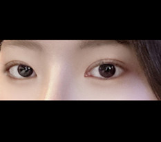 눈수술 상당히 잘나옴!