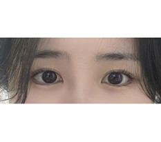 뒤밑트임 후기에용~~~