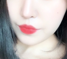 베리베리 만조쿠 입꼬리수술!!