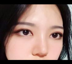 절개 쌍꺼풀, 앞트임, 코 후기