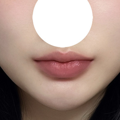 밋밋한 입술변화 큐피트라인 입술성형 전후!