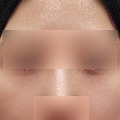 눈밑지방재배치 효과