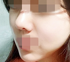 윤곽수술했어요 후기 올립니다 ㅎㅎ