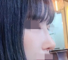 o0o 코수술 한달차 경과!!