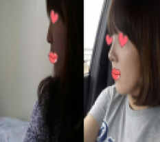 드뎌 매부리코에서 탈출 !