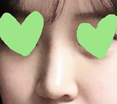 코성형 고민하시는 분들~!!!!!! 말해모해