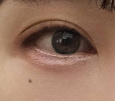 절개쌍수가 답이었네용