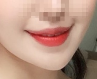 입꼬리수술 후기!!!!