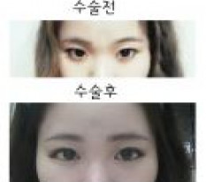 쌍수 매몰이랑 듀얼트임 했어요!
