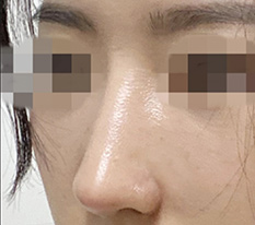 코수술 한달차 후기 올리러 또 왔어요^^