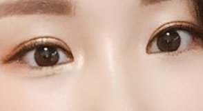 쌍꺼풀 수술 후기