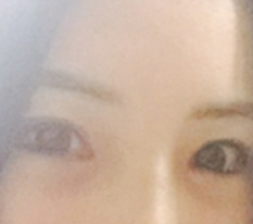 눈재수술받았어여 ㅠㅠㅠㅠ