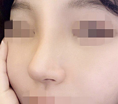 고민 끝에 코수술했어용 ㅎㅎ 대성공~